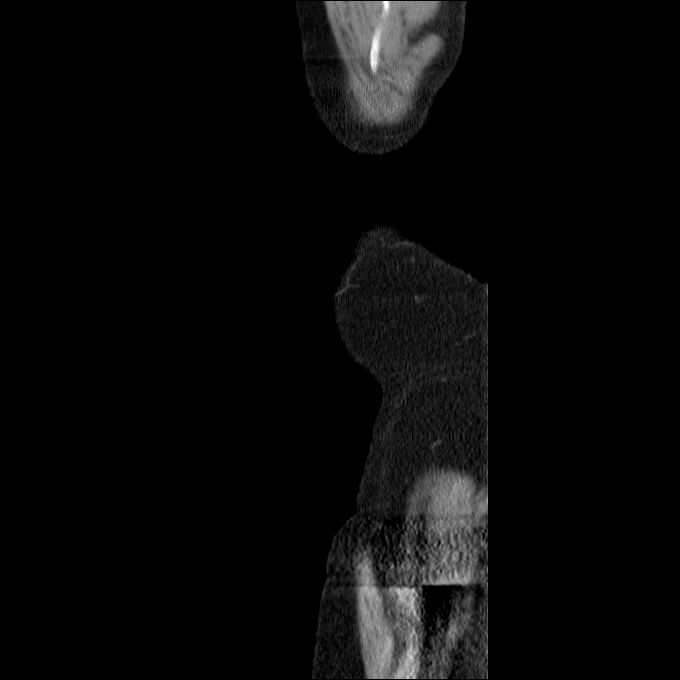 Acute cholecystitis and incidental left sided IVC (Radiopaedia 49352-54459 Sagittal C+ portal venous phase 90).jpg