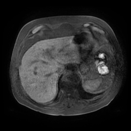 File:Acute cholecystitis complicated by pylephlebitis (Radiopaedia 65782-74915 Axial T1 fat sat 19).jpg
