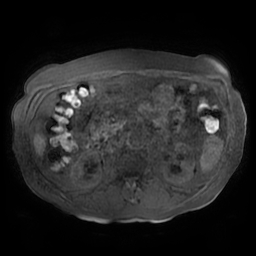 Acute cholecystitis complicated by pylephlebitis (Radiopaedia 65782-74915 Axial T1 fat sat 78).jpg