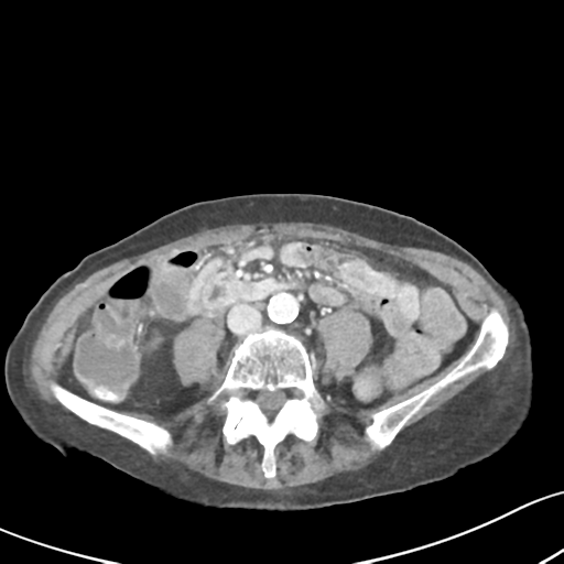 Acute cholecystitis with contained perforation (Radiopaedia 47328-51907 Axial C+ portal venous phase 43).png