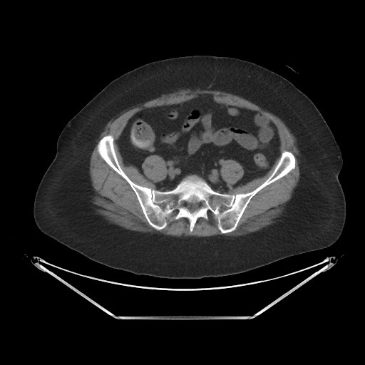 File:Acute cholecystitis with tensile fundus sign (Radiopaedia 71394-81723 Axial non-contrast 84).jpg