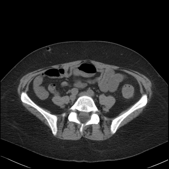 Acute colonic hemorrhage in ulcerative colitis (Radiopaedia 77415-89538 Axial non-contrast 91).jpg