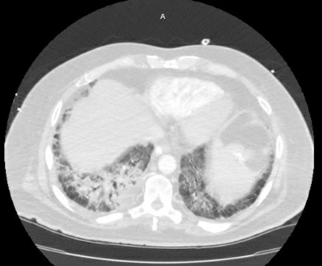 Acute cor pulmonale (ultrasound) (Radiopaedia 83508-98818 Axial lung window 67).jpg