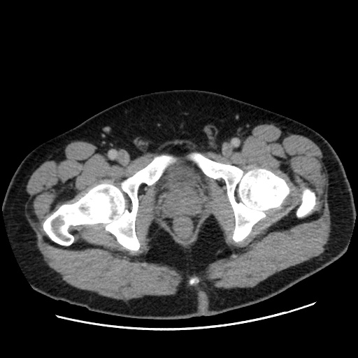 Acute diverticulitis with localized perforation (Radiopaedia 41296-44113 Axial C+ portal venous phase 90).jpg