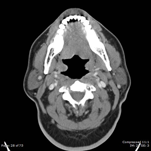 Acute epiglottitis (Radiopaedia 54375-60590 Axial C+ arterial phase 28).jpg