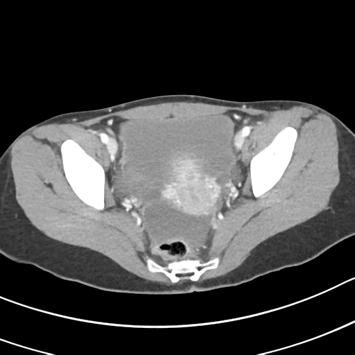 Acute gangrenous appendicitis with perforation (Radiopaedia 40152-42662 Axial C+ portal venous phase 65).png