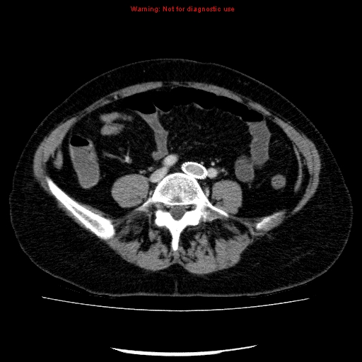 Acute gangrenous cholecystitis (Radiopaedia 10123-10661 Axial C+ portal venous phase 69).jpg