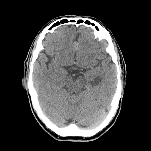 File:Acute hippocampal infarction (Radiopaedia 10610-11071 non-contrast 5).jpg