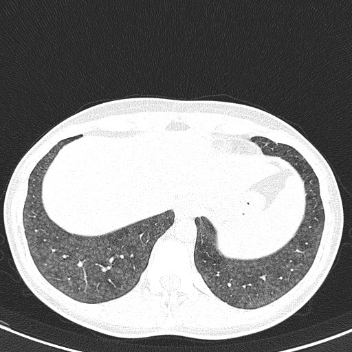 File:Acute hypersensitivity pneumonitis (Radiopaedia 85293-100870 Axial lung window 103).jpg