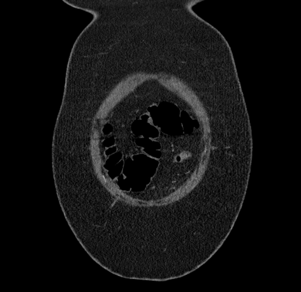 Acute mesenteric ischemia (Radiopaedia 80029-93316 Coronal C+ arterial phase 2).jpg