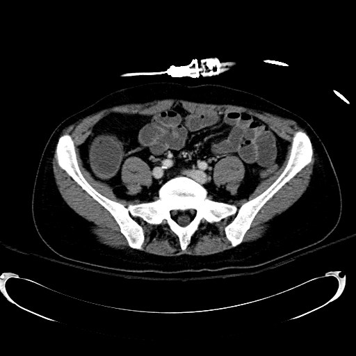 Acute myocardial infarction in CT (Radiopaedia 39947-42415 Axial C+ portal venous phase 91).jpg