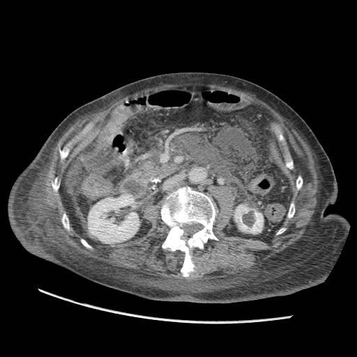 Acute on chronic pancreatitis (Radiopaedia 13233-13244 Axial C+ portal venous phase 51).jpg