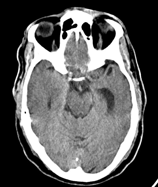 Acute on chronic subdural hematoma (Radiopaedia 78346-90966 Axial non-contrast 26).jpg