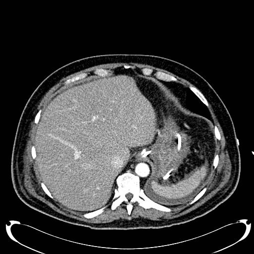 Acute pancreatic necrosis (Radiopaedia 13560-18500 Axial C+ portal venous phase 31).jpg
