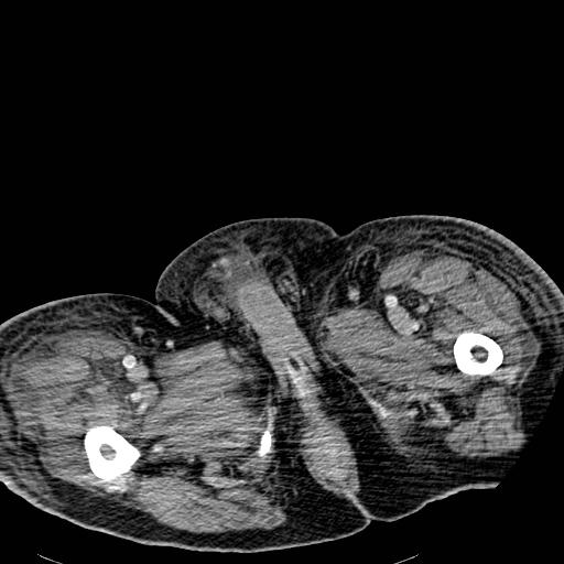 Acute pancreatic necrosis (Radiopaedia 13560-18501 Axial C+ portal venous phase 164).jpg