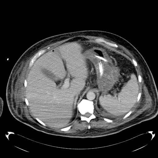File:Acute pancreatic necrosis (Radiopaedia 13560-18503 Axial C+ portal venous phase 17).jpg