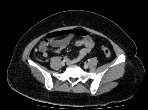 Acute pancreatitis (Radiopaedia 69236-79012 Axial C+ portal venous phase 67).jpg