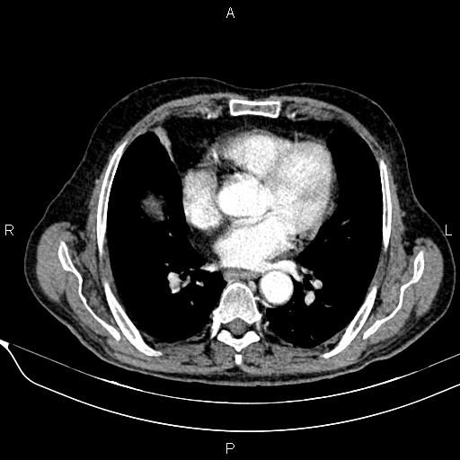 File:Acute pancreatitis (Radiopaedia 85146-100701 Axial C+ arterial phase 13).jpg