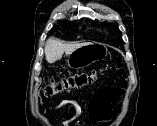 Acute pancreatitis (Radiopaedia 85146-100701 Coronal C+ portal venous phase 8).jpg