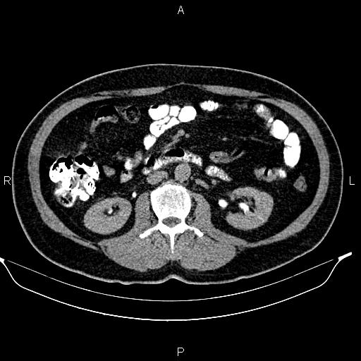 File:Acute pancreatitis (Radiopaedia 85390-101010 Axial C+ delayed 41).jpg