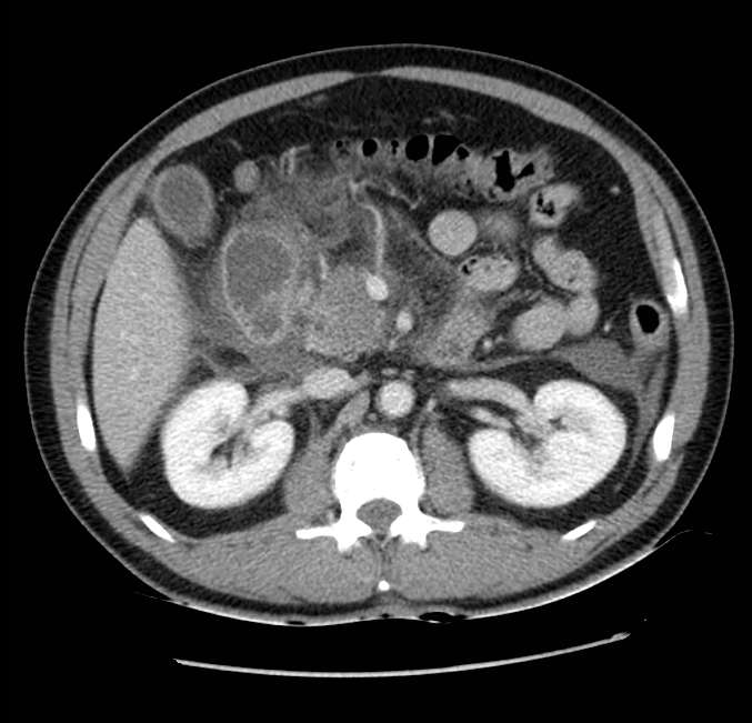 Acute pancreatitis - Balthazar E (Radiopaedia 23080-23110 Axial C+ portal venous phase 27).jpg