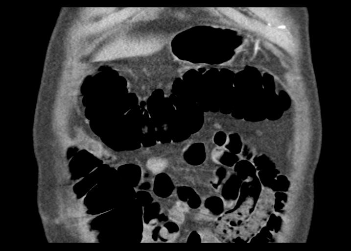Acute pancreatitis and walled-off necrosis (Radiopaedia 29888-30403 Coronal C+ portal venous phase 12).jpg