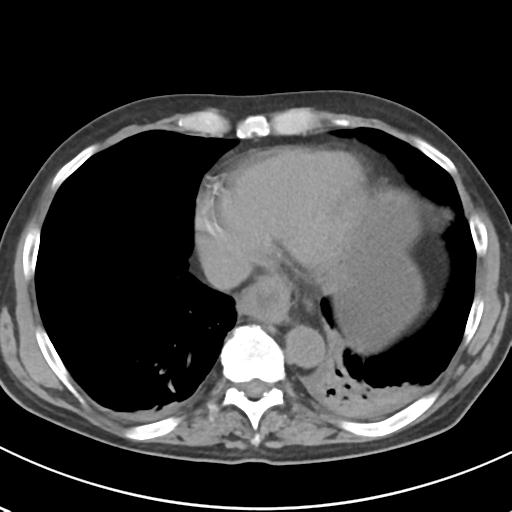 File:Acute pancreatitis and walled-off necrosis (Radiopaedia 29888-30404 Axial non-contrast 4).jpg
