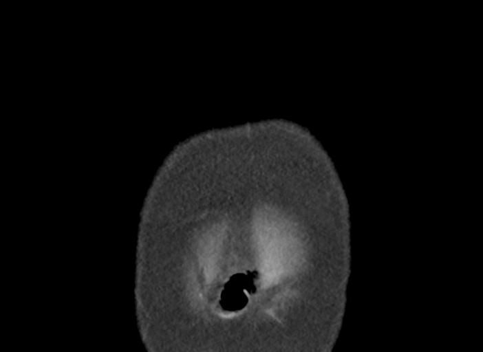 Acute pancreatitis and walled-off necrosis (Radiopaedia 29888-30404 Coronal C+ portal venous phase 3).jpg