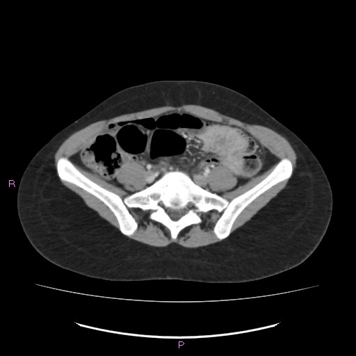 File:Acute pancreatitis secondary to stone at minor papilla and pancreatic divisum (Radiopaedia 76570-88333 Axial C+ portal venous phase 54).jpg
