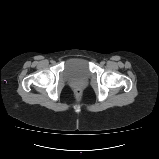 Acute pancreatitis secondary to stone at minor papilla and pancreatic divisum (Radiopaedia 76570-88333 Axial non-contrast 78).jpg