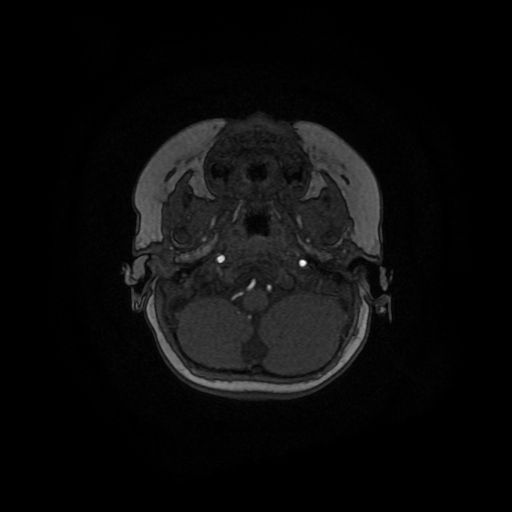 Acute phase of hemiconvulsion-hemiplegia epilepsy syndrome (Radiopaedia 29309-29745 Axial TOF angiography 139).jpg