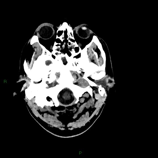 Acute posterior cerebral artery territory infarct (Radiopaedia 79329-92393 Axial non-contrast 12).jpg