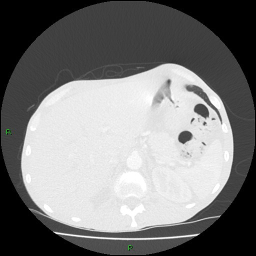 File:Acute right lung abscess (Radiopaedia 34806-36258 Axial lung window 183).jpg