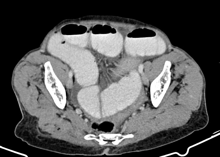 Acute small bowel (ileal) volvulus (Radiopaedia 71740-82139 Axial C+ portal venous phase 166).jpg