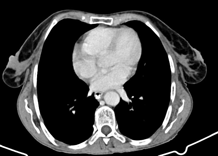 Acute small bowel (ileal) volvulus (Radiopaedia 71740-82139 Axial C+ portal venous phase 24).jpg