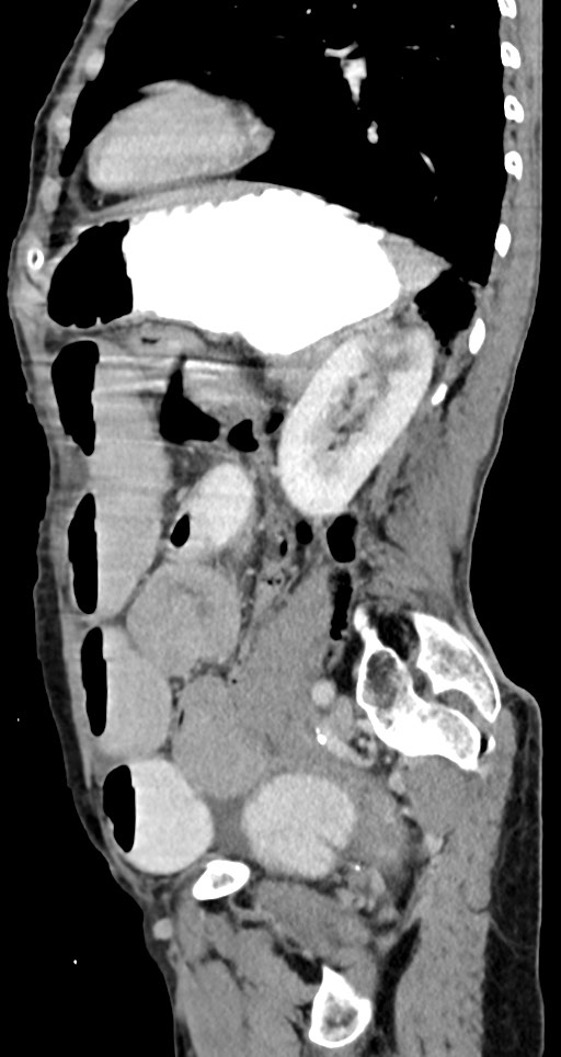 Acute small bowel (ileal) volvulus (Radiopaedia 71740-82139 Sagittal C+ portal venous phase 62).jpg