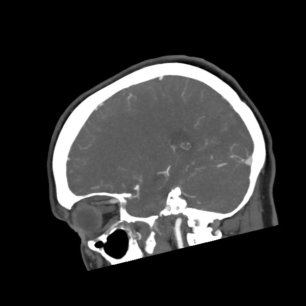 File:Acute subarachnoid hemorrhage and accessory anterior cerebral artery (Radiopaedia 69231-79009 Sagittal C+ arterial phase 27).jpg