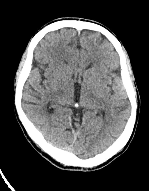 Acute superior cerebellar artery territory infarct (Radiopaedia 84104-99359 Axial non-contrast 38).jpg
