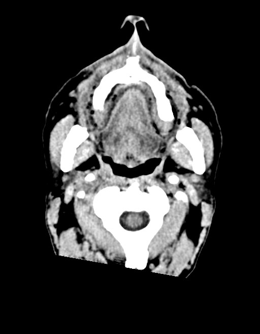 Acute superior cerebellar artery territory infarct (Radiopaedia 84104-99359 Axial non-contrast 73).jpg