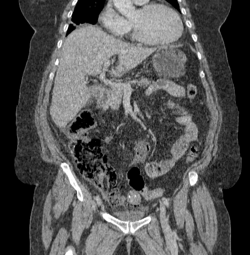 Acute superior mesenteric artery occlusion (Radiopaedia 51288-56960 Coronal C+ portal venous phase 34).jpg