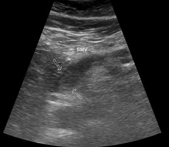 File:Acute superior mesenteric vein thrombosis (Radiopaedia 26696-26853 G 1).jpg