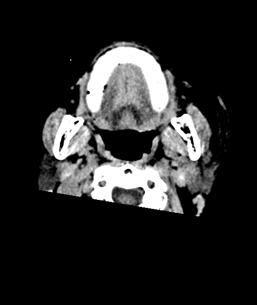 Acute traumatic subdural hematoma (Radiopaedia 82921-97257 Axial non-contrast 69).jpg