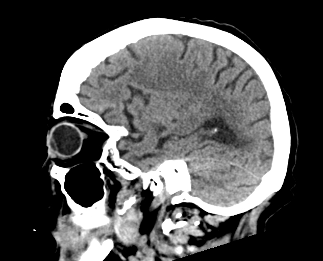 File:Acute traumatic subdural hematoma (Radiopaedia 82921-97257 Sagittal non-contrast 26).jpg