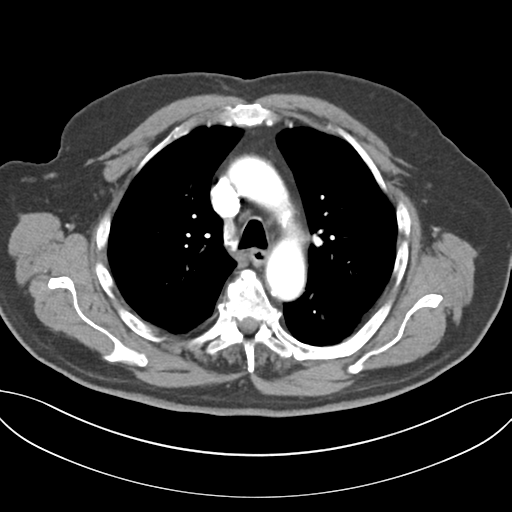 Adenocarcioma of rectum- T1 lesion (Radiopaedia 36921-38547 Axial C+ arterial phase 21).png