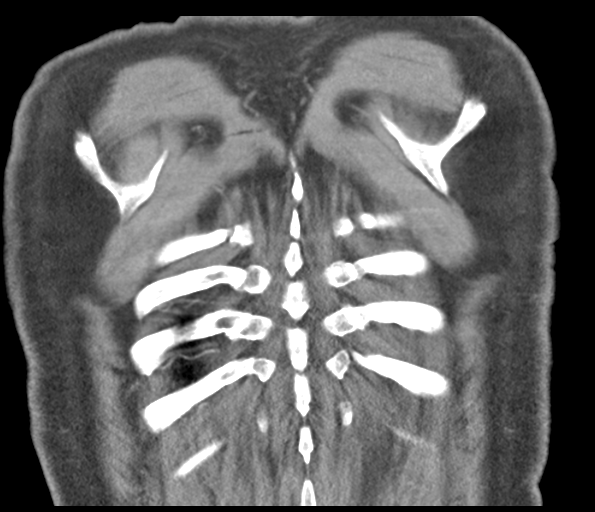 Adenocarcioma of rectum- T1 lesion (Radiopaedia 36921-38547 Coronal C+ arterial phase 56).png