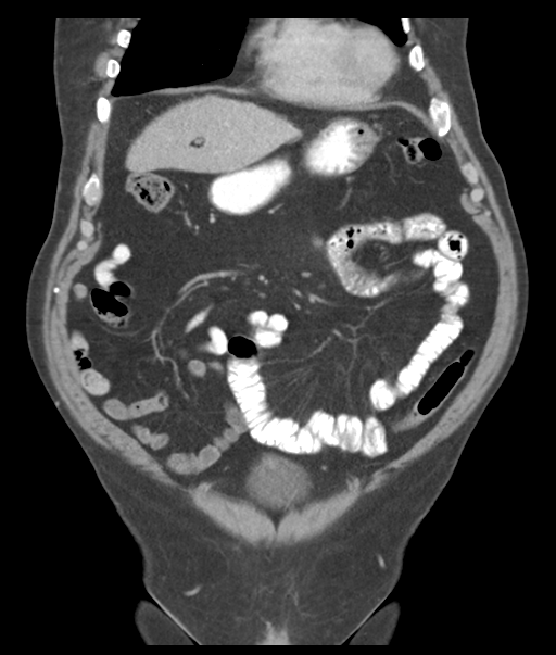 Adenocarcioma of rectum- T1 lesion (Radiopaedia 36921-38547 Coronal C+ portal venous phase 19).png