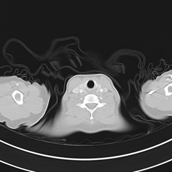 File:Adenocystic carcinoma of the trachea (Radiopaedia 47677-52525 Axial lung window 23).jpg