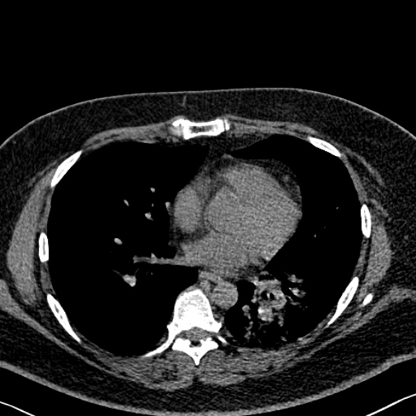 Adenoid cystic carcinoma of the trachea (Radiopaedia 49042-54137 Axial non-contrast 204).jpg