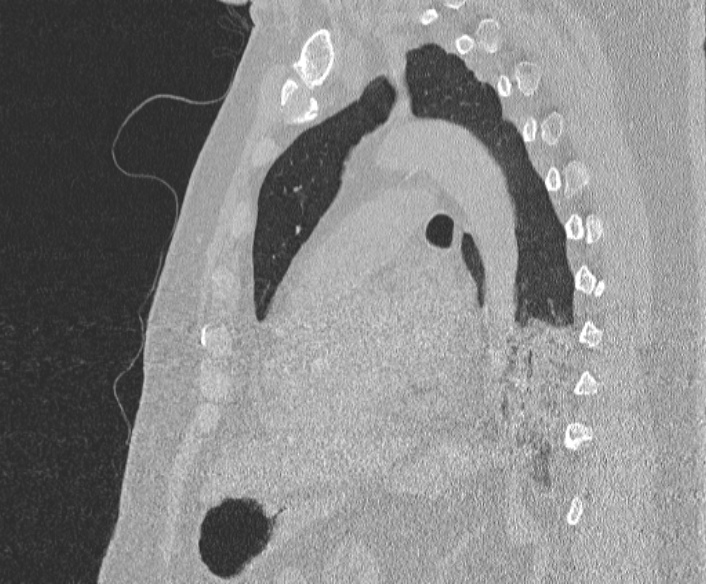 Adenoid cystic carcinoma of the trachea (Radiopaedia 49042-54137 Sagittal lung window 280).jpg