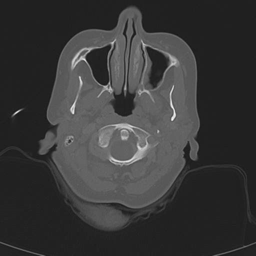 Adenoid cystic tumor of palate (Radiopaedia 46980-51518 Axial bone window 24).png